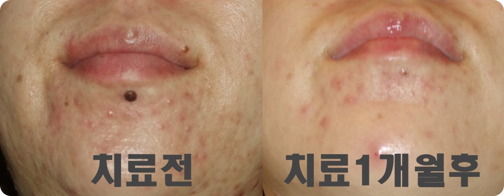 창원후한의원 돌출점 제거 전후 비교