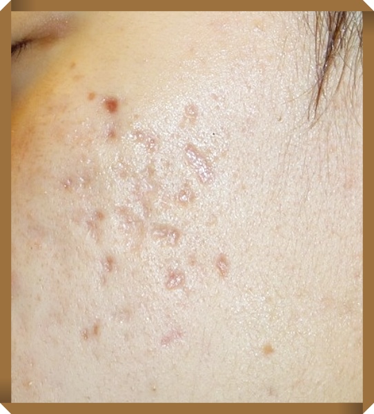 창원흉터치료 흉터질환 내원당시사진