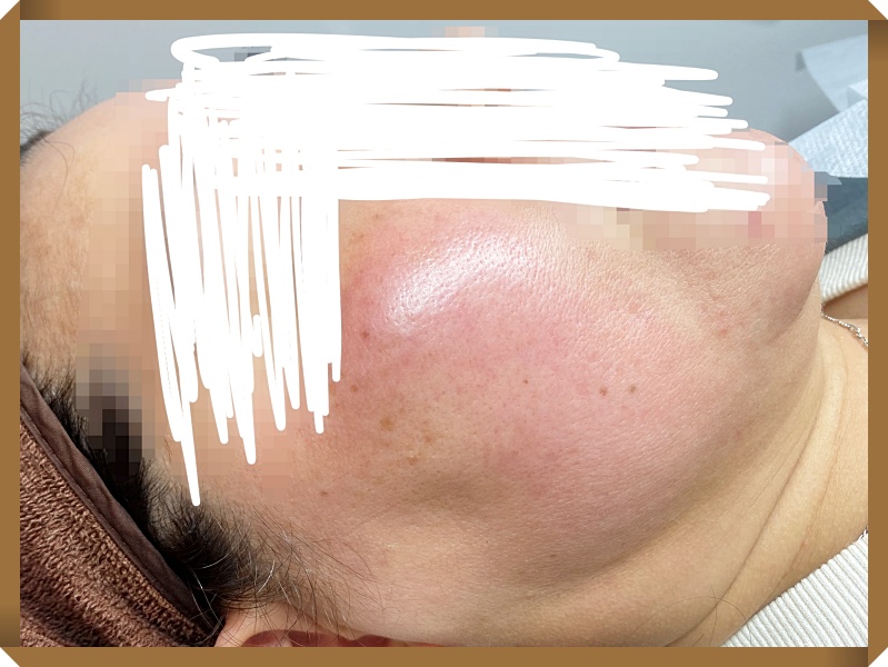 창원안면홍조치료 초기상태사진
