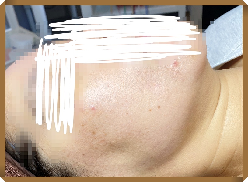 창원안면홍조치료 치료후 얼굴사진