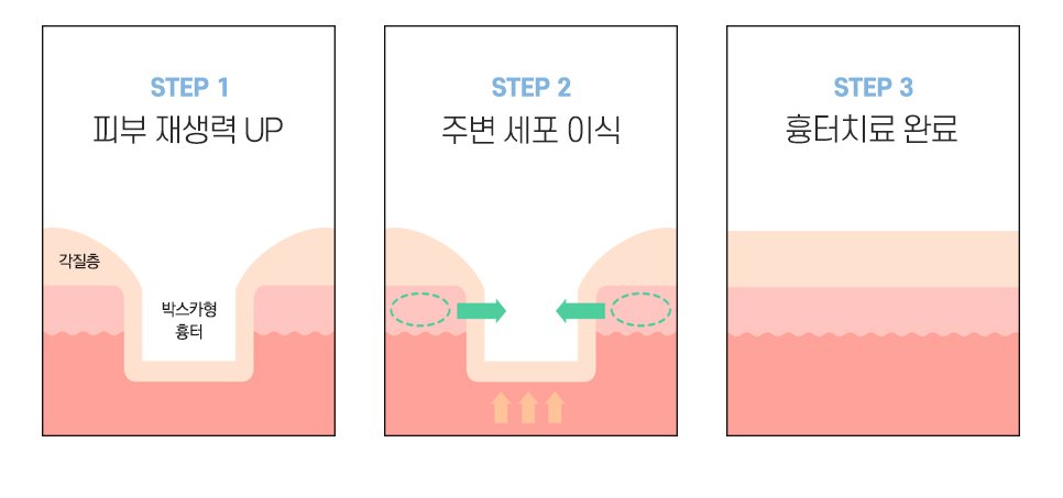 새살침 흉터치료 원리 피부재생 세포이식 3단계