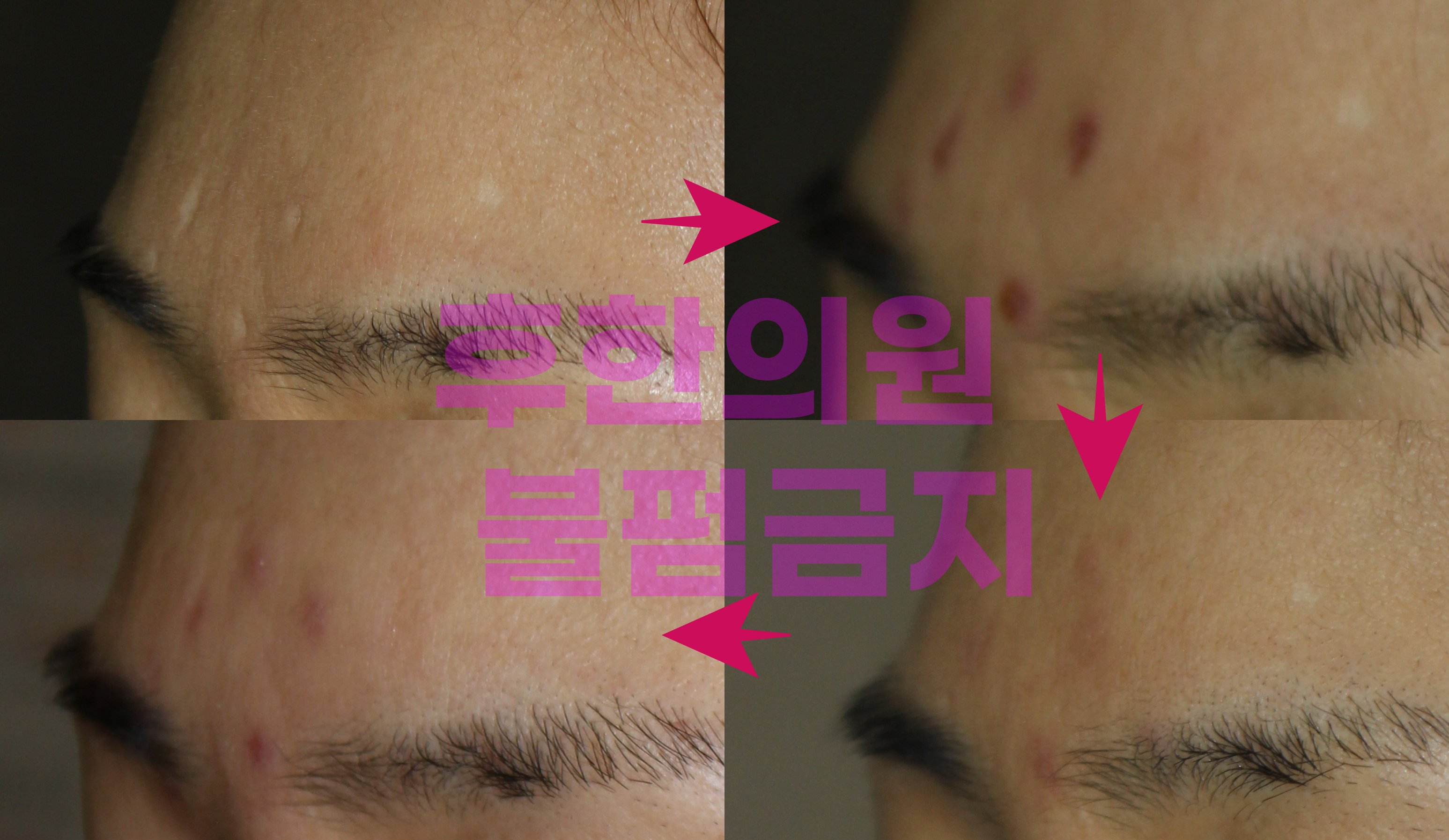 창원수두흉터 새살침 1회 시술 후 경과사진