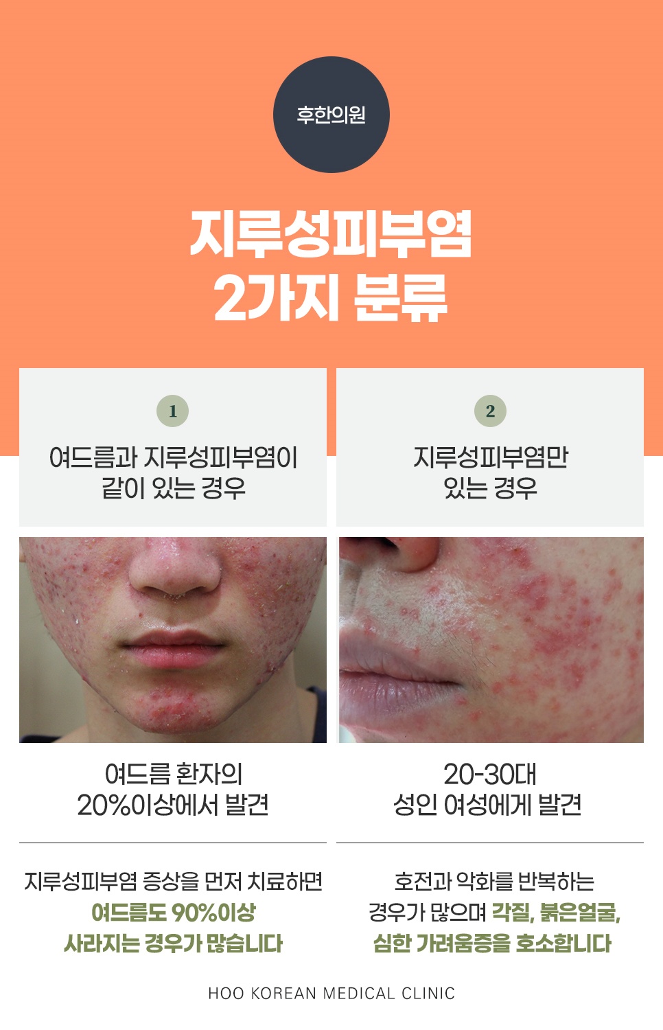 창원 지루성피부염, 여드름 동반 여부에 따른 2가지 분류와 실제 환자 사진 비교