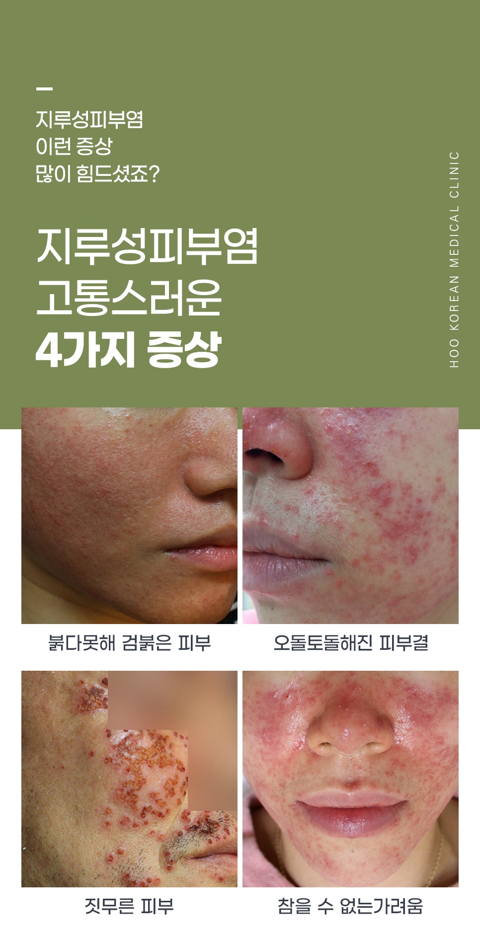 창원 지루성피부염의 대표 증상 4가지 - 붉은기, 오돌토돌한 피부결, 짓무름, 가려움