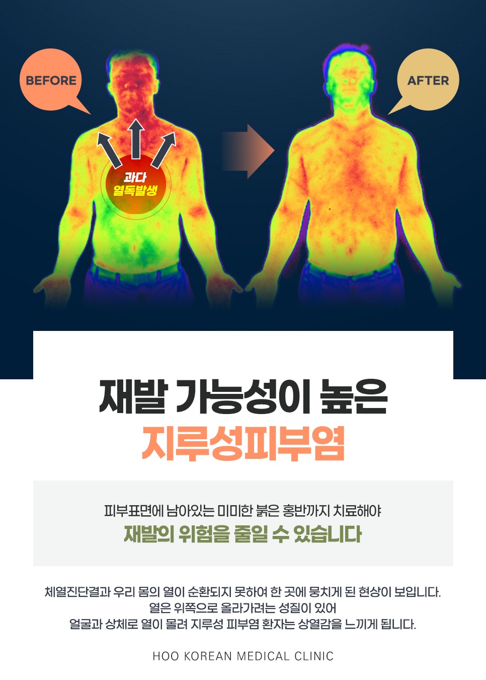 창원 지루성피부염 재발 원인이 되는 상열감·열독을 보여주는 체열 촬영 전후 비교