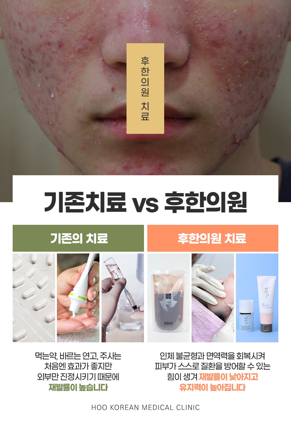 창원 지루성피부염 기존 치료(연고·주사)와 후한의원 한약·시술 치료 방식 비교