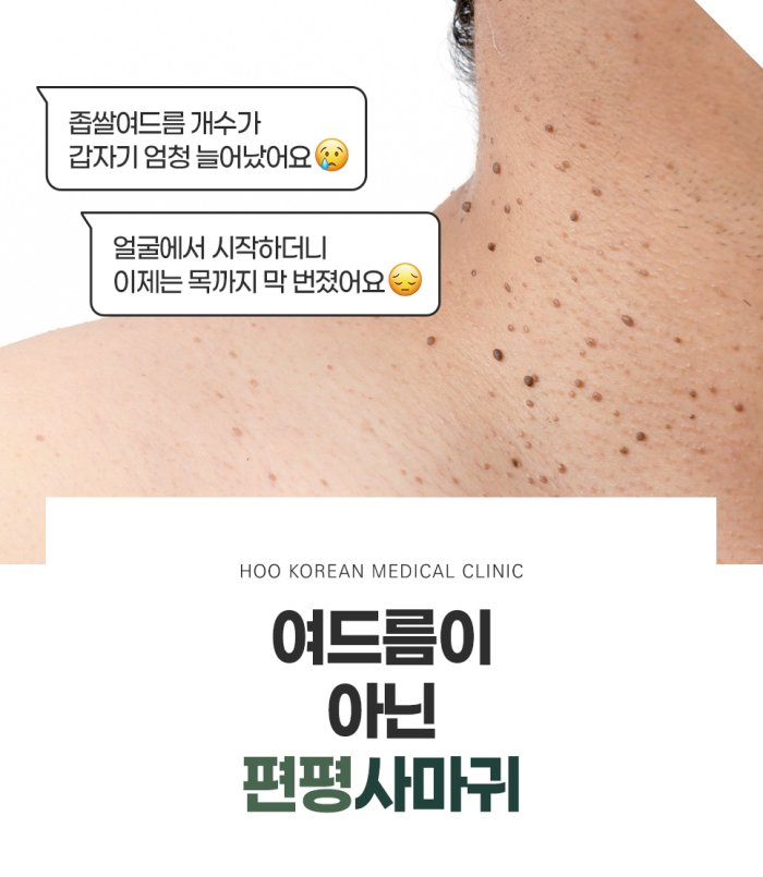 좁쌀여드름으로 착각하는 목 편평사마귀 실제 사진