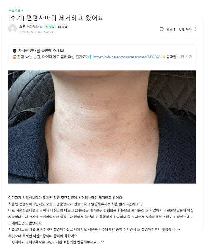 창원 후한의원 편평사마귀 제거 시술 직후 후기