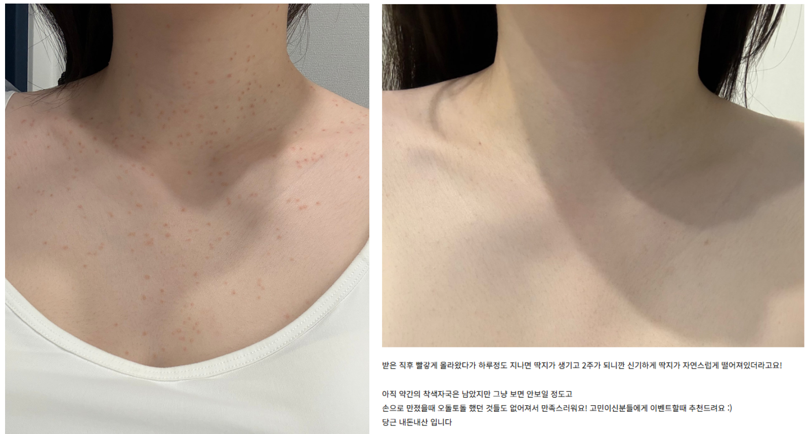 편평사마귀 레이저 시술 전 목 가슴 사진 2주 전후