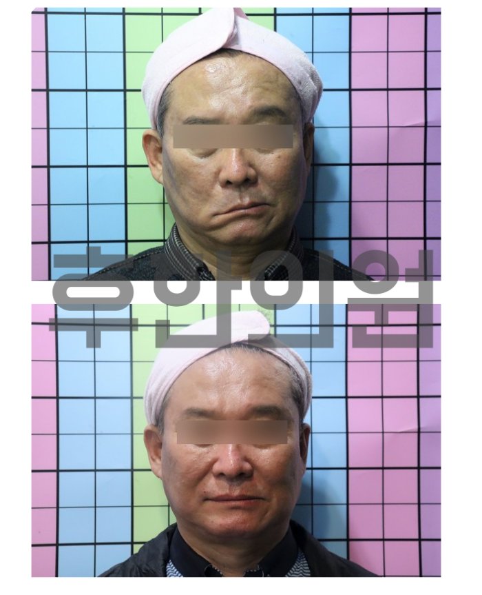 창원안면마비 침치료 병행 전후 비교 사진