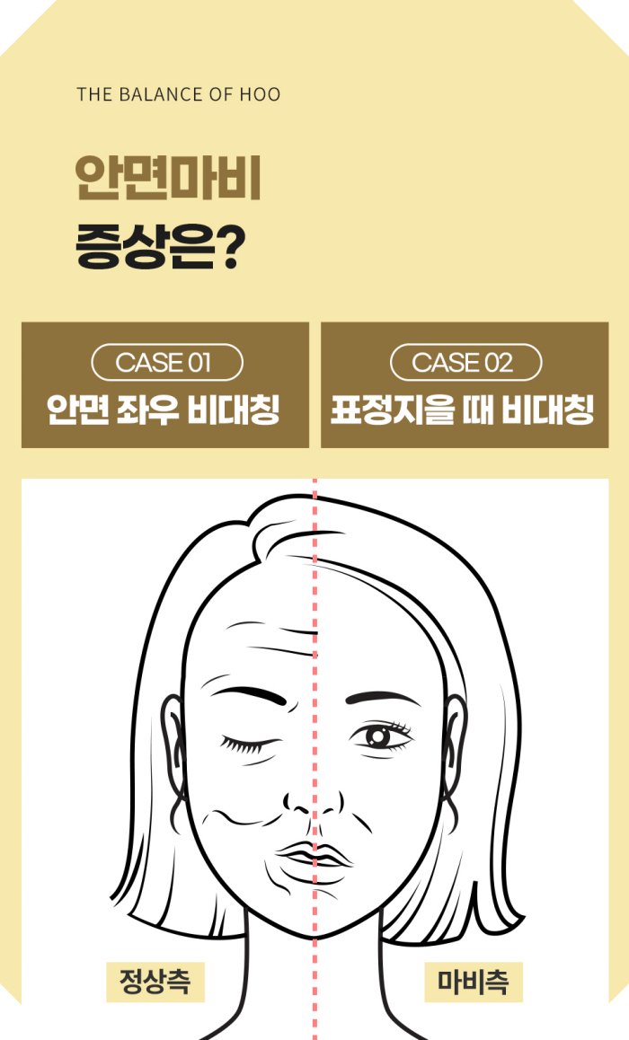 창원안면마비 증상 좌우비대칭 표정비대칭 체크리스트