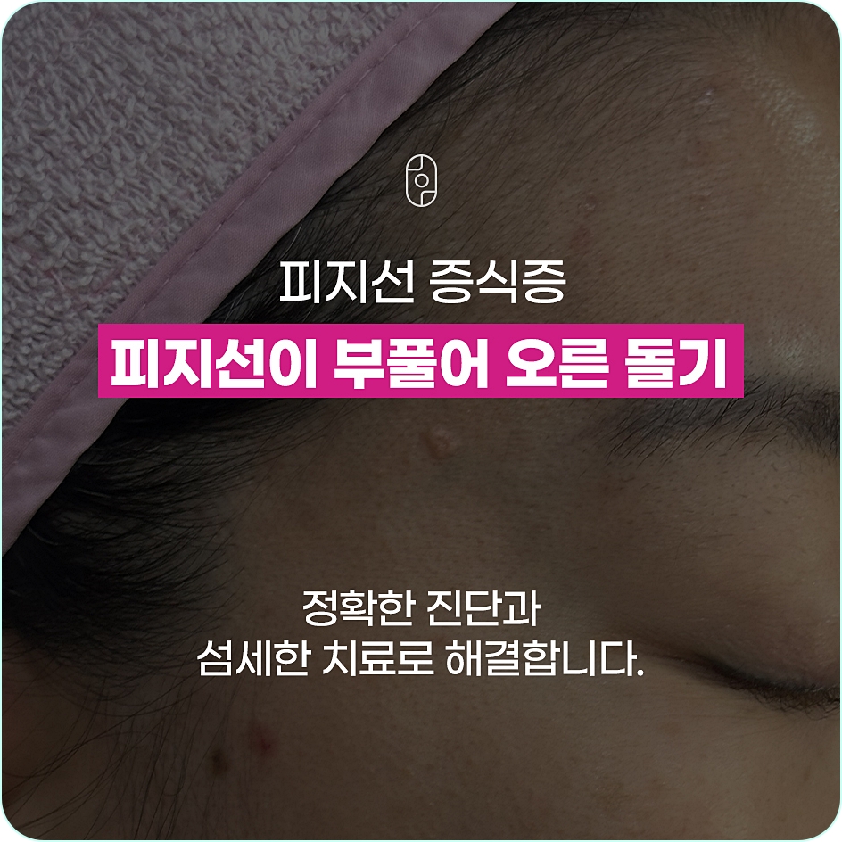 창원피지선증식증 질환 간단한 설명 문구 이미지