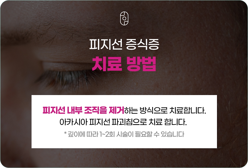 창원피지선증식증제거 피지선파괴침 치료 안내