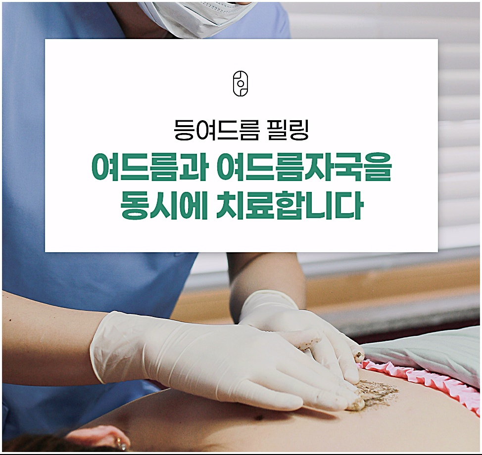 창원 등드름 필링으로 여드름과 여드름자국을 동시에 치료하는 모습