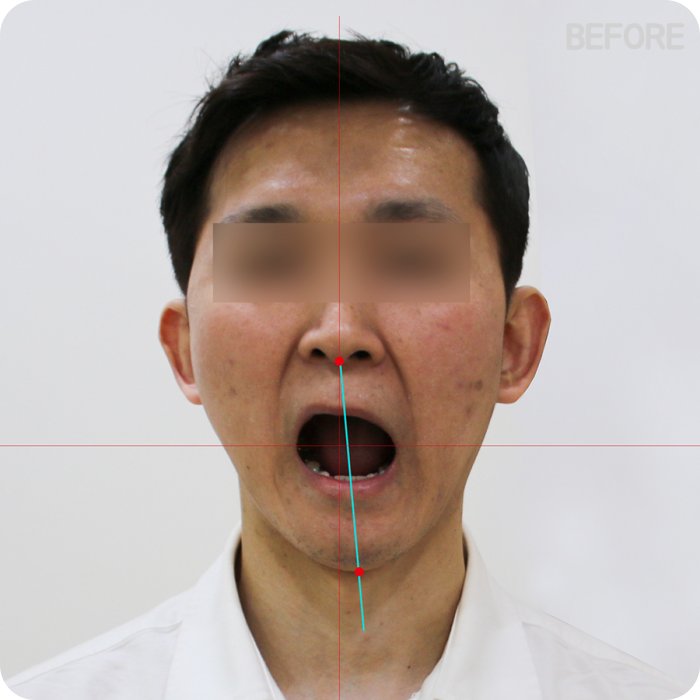 남성 안면비대칭 증상 - 입 벌림시 턱 편향