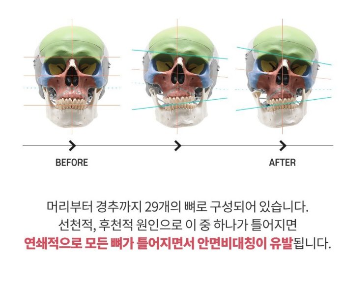 두개골 구조 안면비대칭 분석 - Before/After 교정 과정 비교