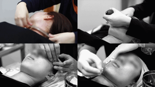창원안면비대칭교정 치료 과정 - MCT 근육근막 치료, 정안침 시술