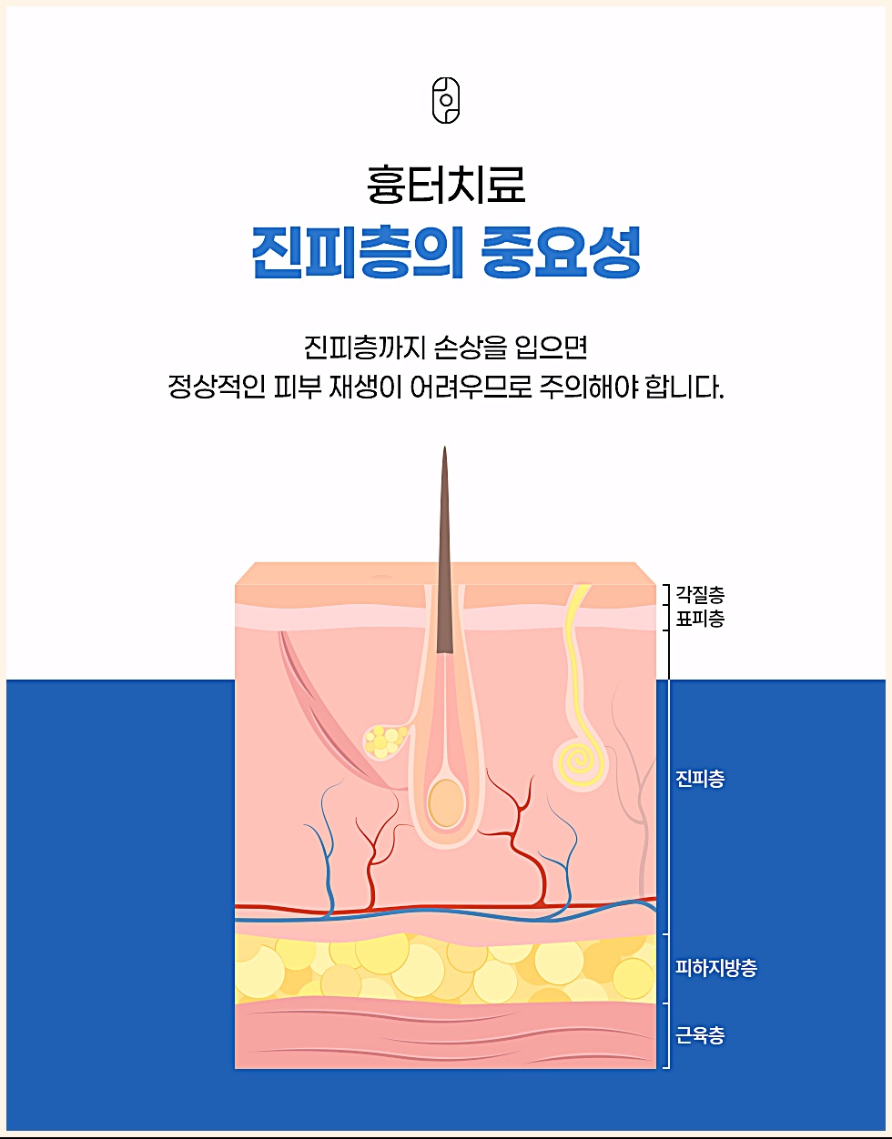 여드름흉터 치료 시 진피층 손상의 중요성을 보여주는 피부 단면도