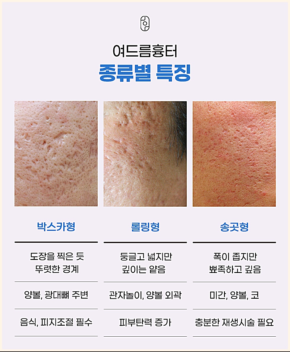 박스카형 롤링형 송곳형 여드름흉터 종류별 특징 비교 이미지