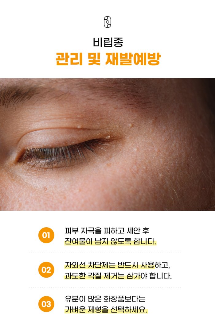 창원비립종 예방법