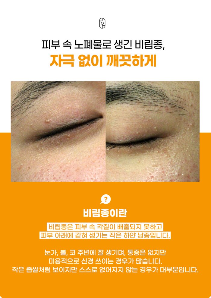 창원비립종 자주 묻는 질문, 직접 짜면 안 되는 이유와 계속 생기는 원인 설명