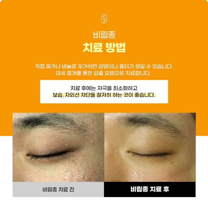 창원비립종 치료 전 후 사진 
