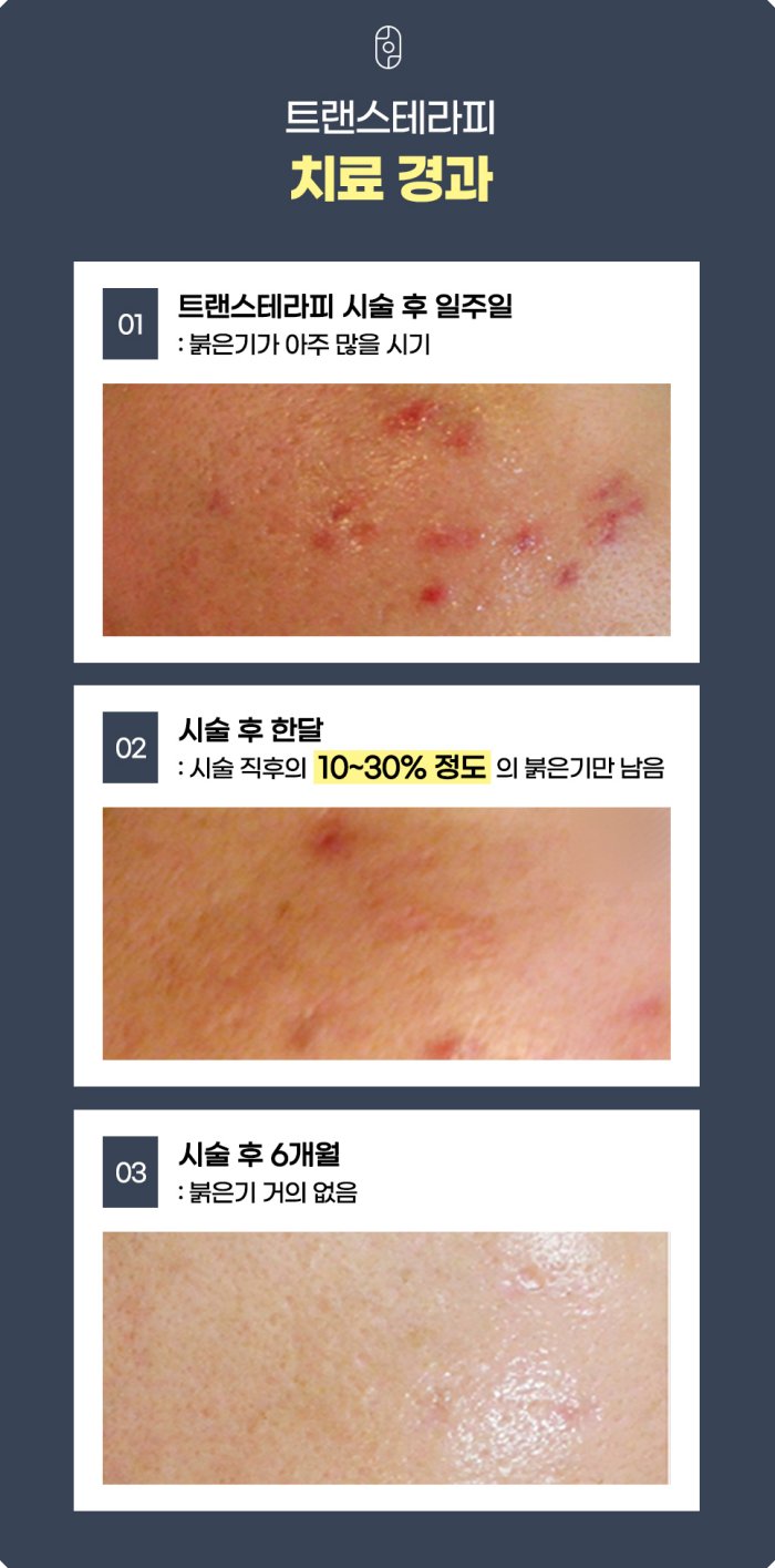 창원여드름흉터 새살침(트랜스테라피) 치료 경과 - 시술 후 일주일(붉은기 많을 시기), 시술 직후 10~30% 붉음, 시술 후 6개월 붉음 거의 없음까지의 3단계 회복 과정