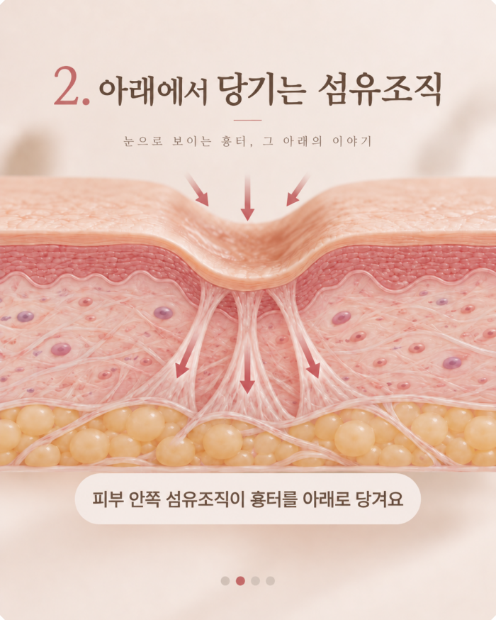 창원여드름흉터 원인 설명 - 