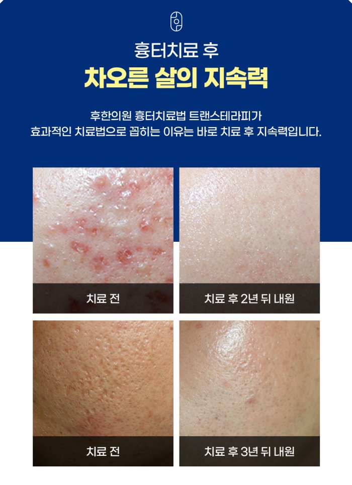창원여드름흉터 새살침 치료 실제 사례 - 좌측 상단 