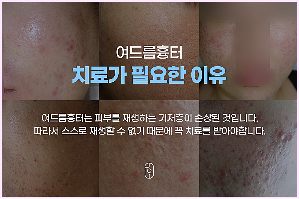  창원 여드름흉터 치료가 필요한 이유 - 기저층 손상으로 인한 흉터 자연치유 불가 설명