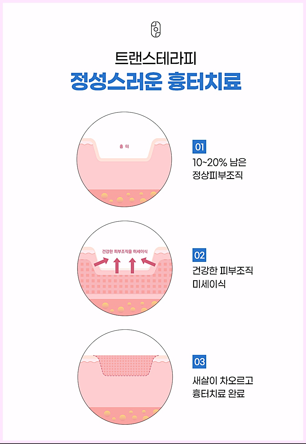 트랜스테라피 흉터 치료 3단계 다이어그램 - 정상피부조직 미세이식으로 새살 차오르는 원리