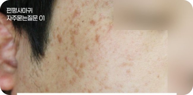 창원편평사마귀 무제한 - 볼과 옆얼굴에 퍼진 갈색 편평사마귀