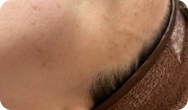 후한의원 창원점 이마와 눈썹 주변 편평사마귀 레이저 치료 후