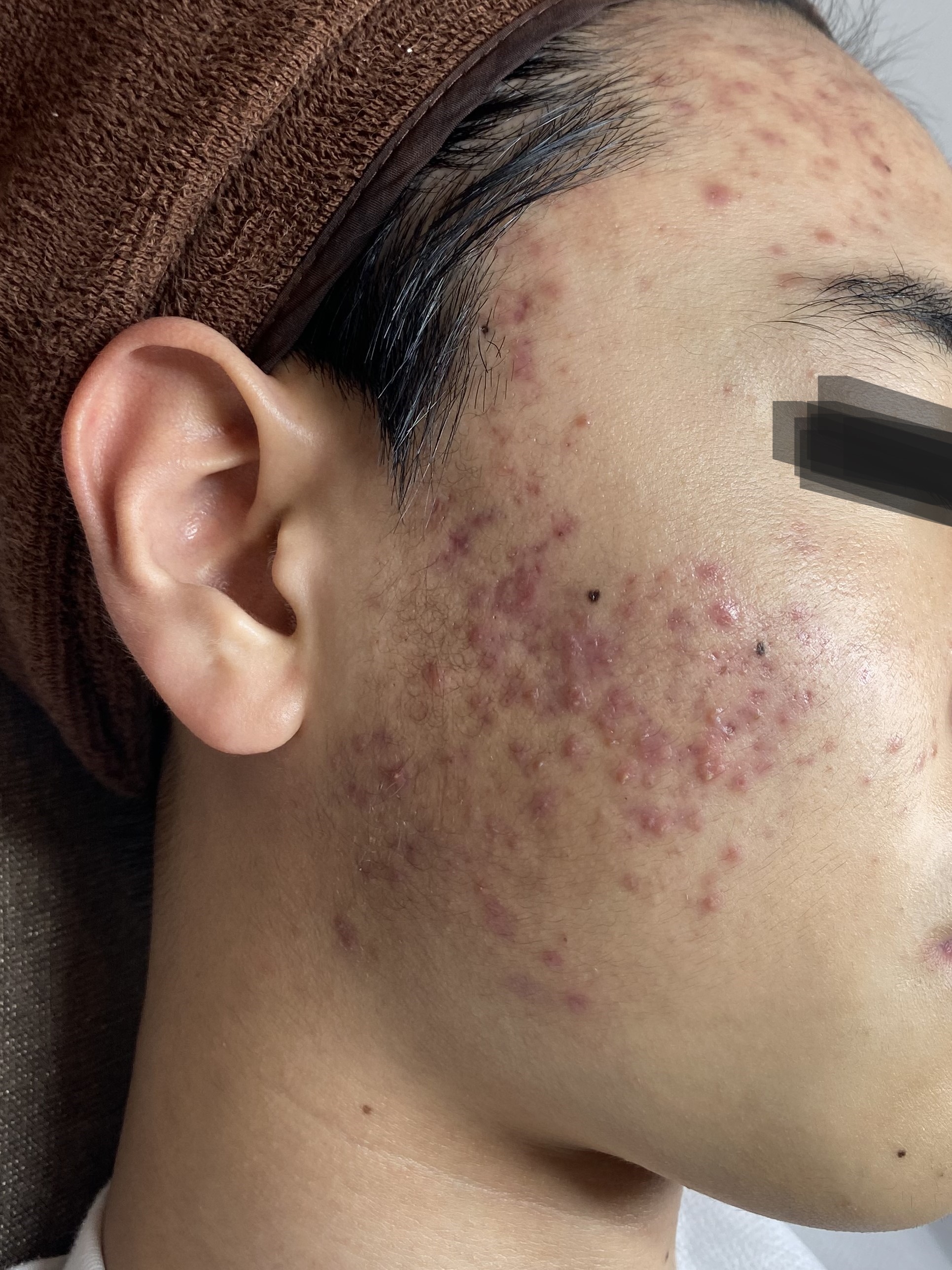 창원여드름한의원 치료 전 사진 - 귀 앞 볼에 뭉친 자줏빛 여드름