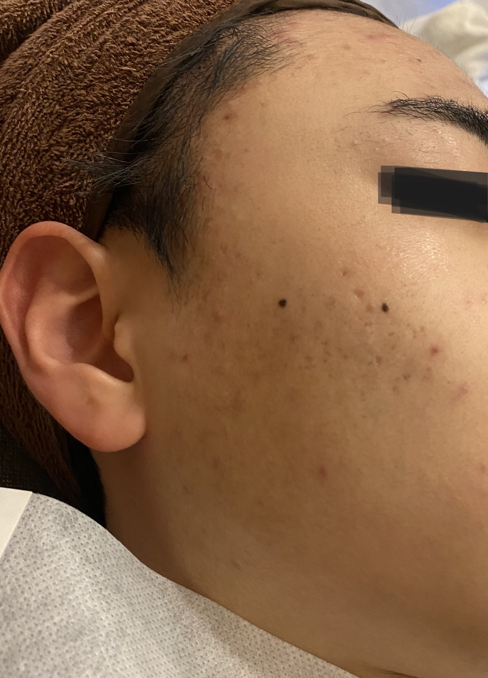 창원여드름한의원 치료 후 사진 - 귀 앞 볼 여드름과 붉은기 개선