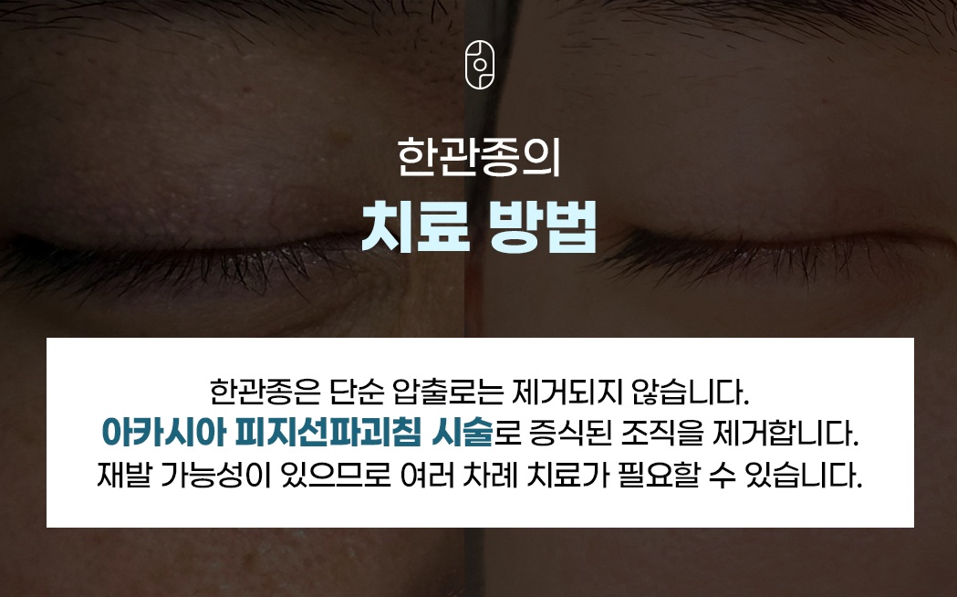 피지선파괴침을 이용한 한관종 치료