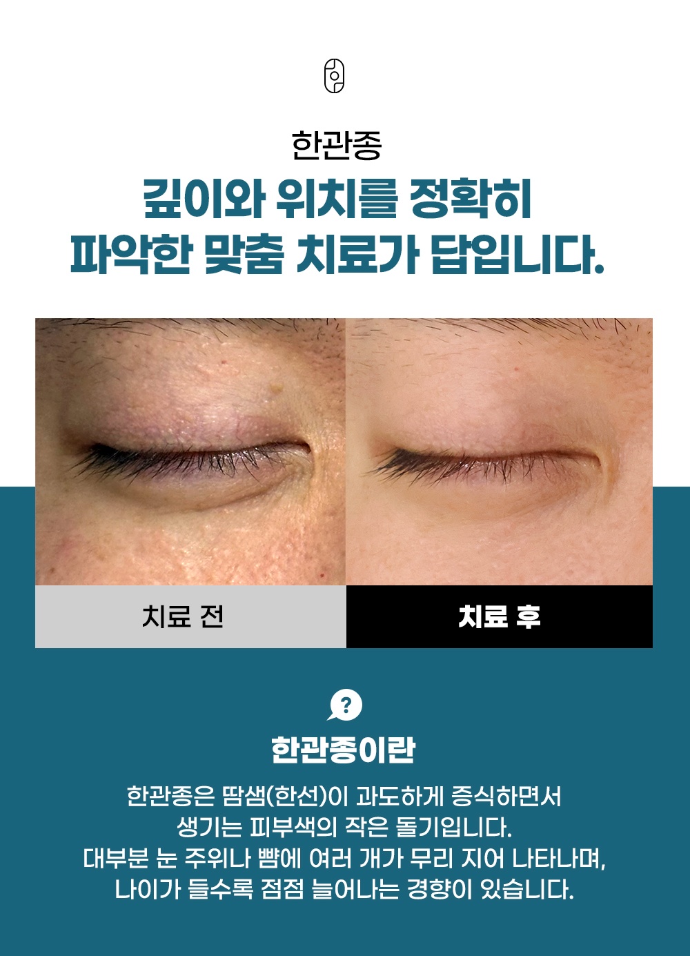 눈가 및 뺨 한관종 증상 특징