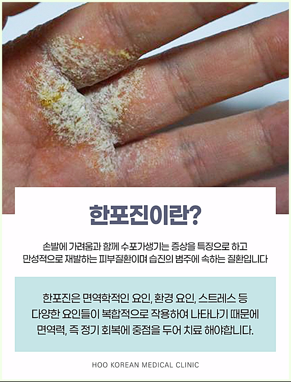 한포진이란? 정의와 면역학적 원인 설명