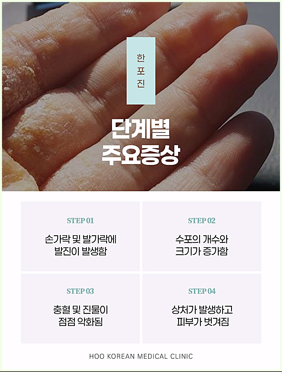 창원 한포진 단계별 주요증상 - 발진부터 진물, 피부 벗겨짐까지