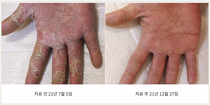 창원한포진 치료 전후 비교 사진