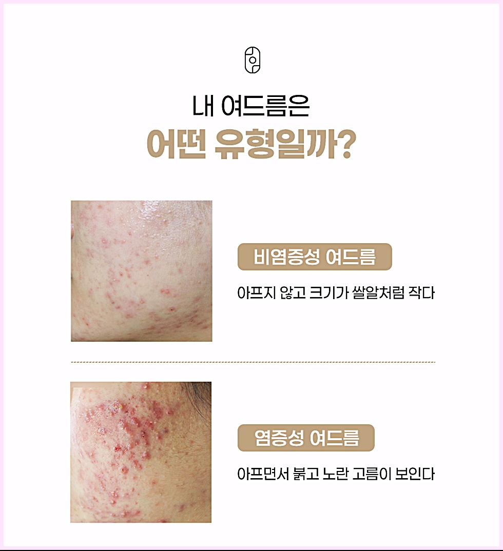 비염증성 여드름과 염증성 여드름의 모양을 비교한 창원여드름압출 유형 안내