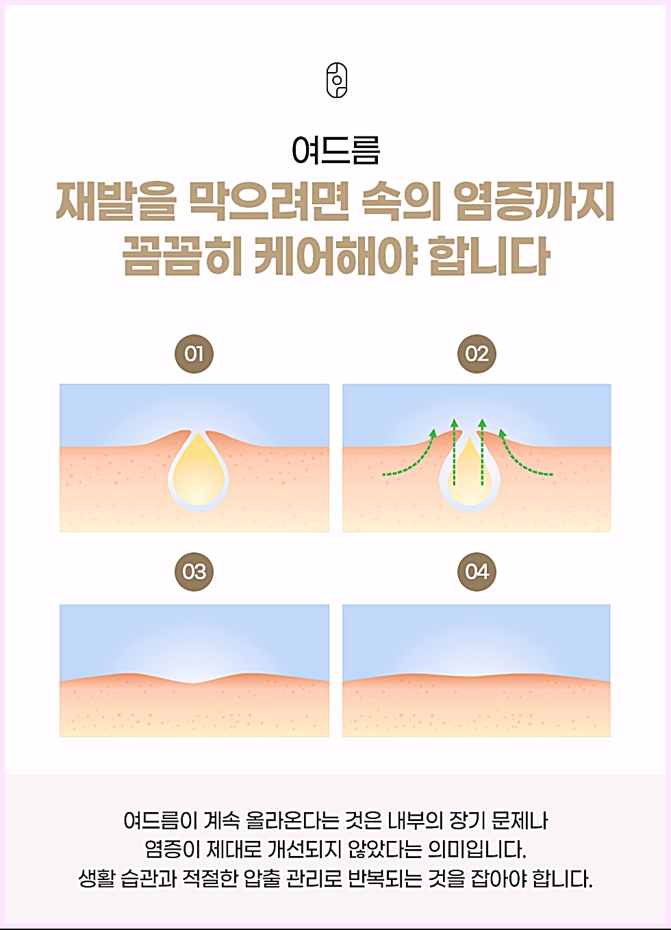 창원여드름압출 모공 속 피지가 쌓여 여드름이 재발하는 과정 4단계