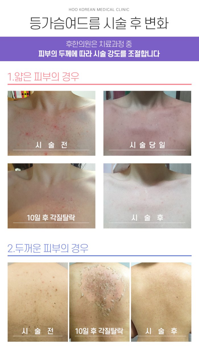 후윤약초필링 시술후 변화