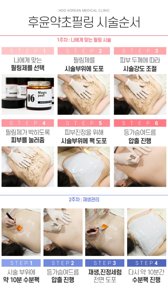 창원가슴여드름치료 후윤약초필링 시술 과정