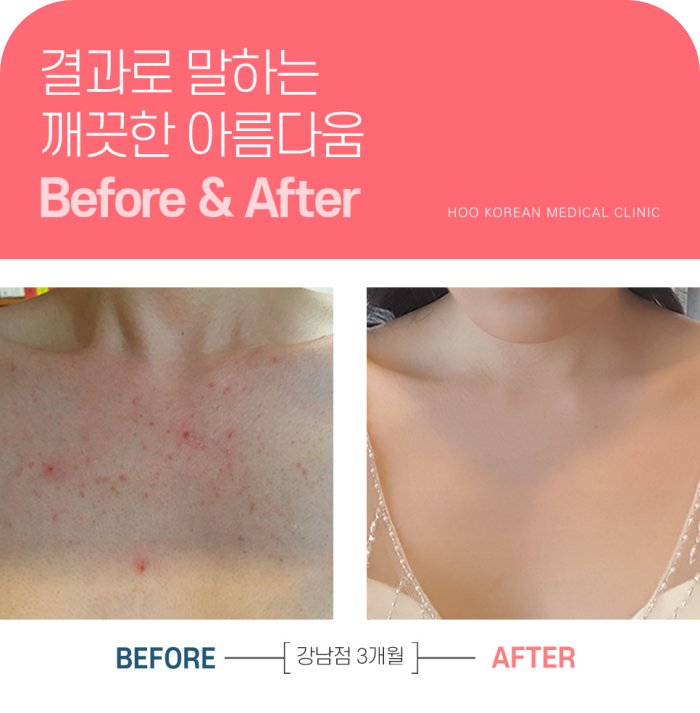 가슴여드름 치료 전후 붉은 염증과 자국 변화 사례