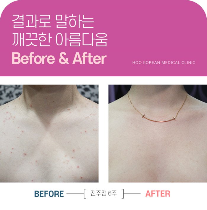 가슴여드름 치료 전후 붉은 염증과 자국 변화 사례2