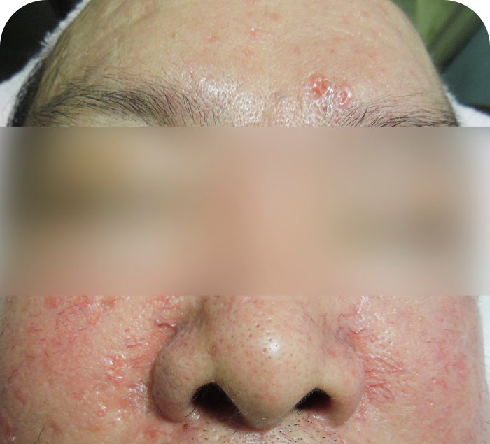  이마 붉은 병변과 코 옆 혈관 확장이 함께 보이는 홍조 동반 지루성피부염 사진
