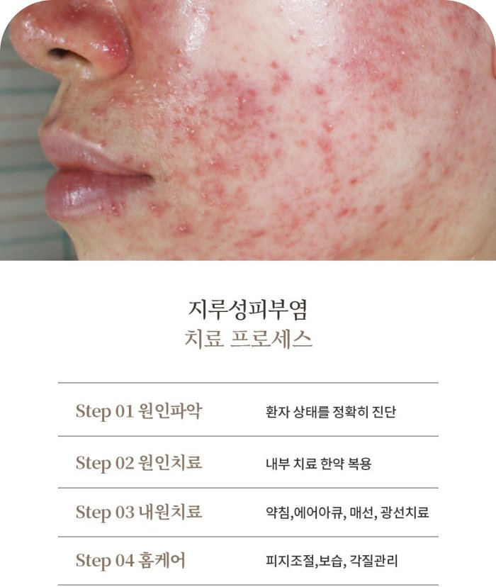 후한의원 지루성피부염 치료 프로세스 4단계, 원인파악·원인치료·내원치료·홈케어