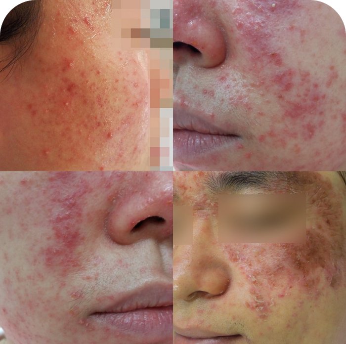 볼, 코 옆, 눈가 등 다양한 부위에 나타난 지루성피부염 증상 사례