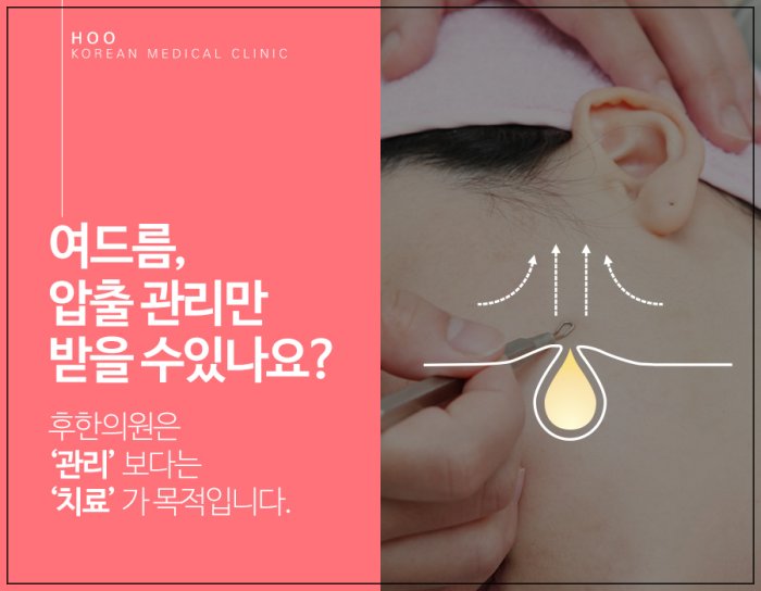 여드름 압출은 관리보다 치료가 목적, 모공 속 피지와 염증을 빼내는 압출 원리 설명 이미지